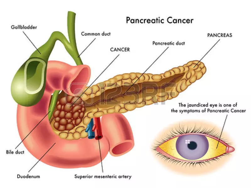 pancreatic-cancer1