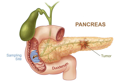 pankreas-kanseri-belirtileri(4)
