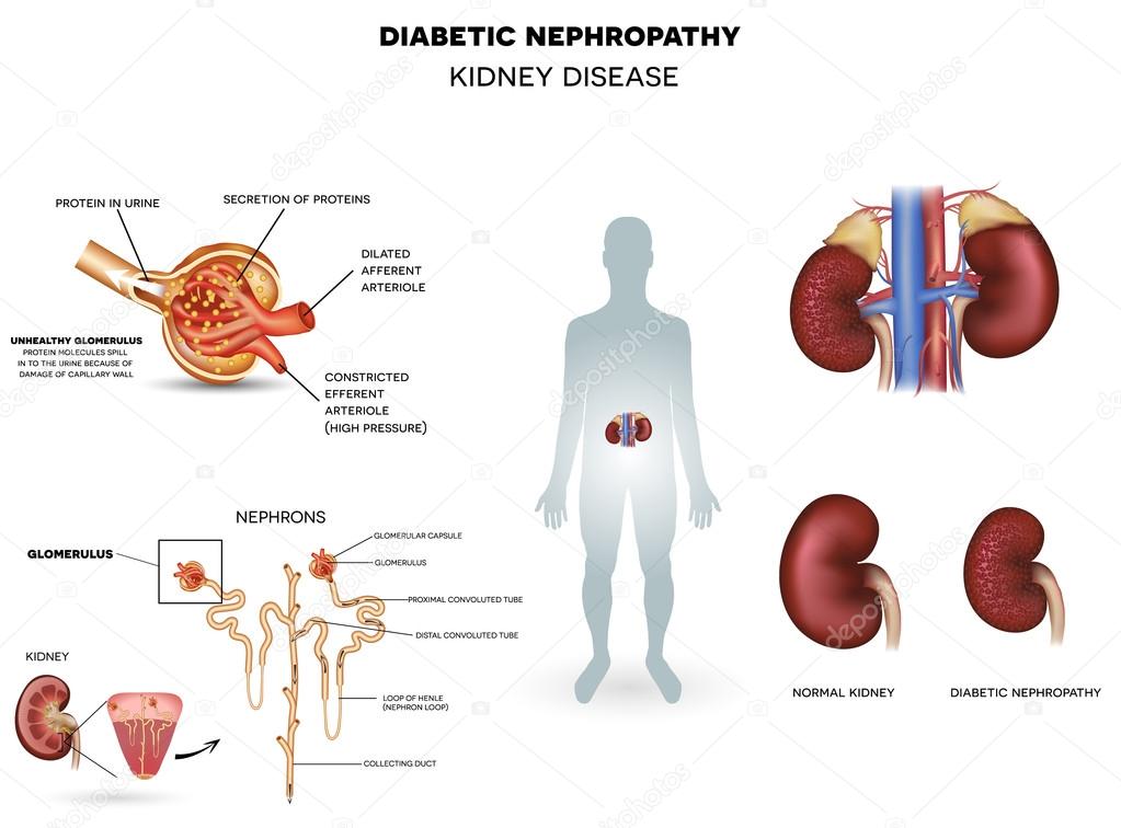 depositphotos_88933684-stock-illustration-diabetic-nephropathy-kidney-disease