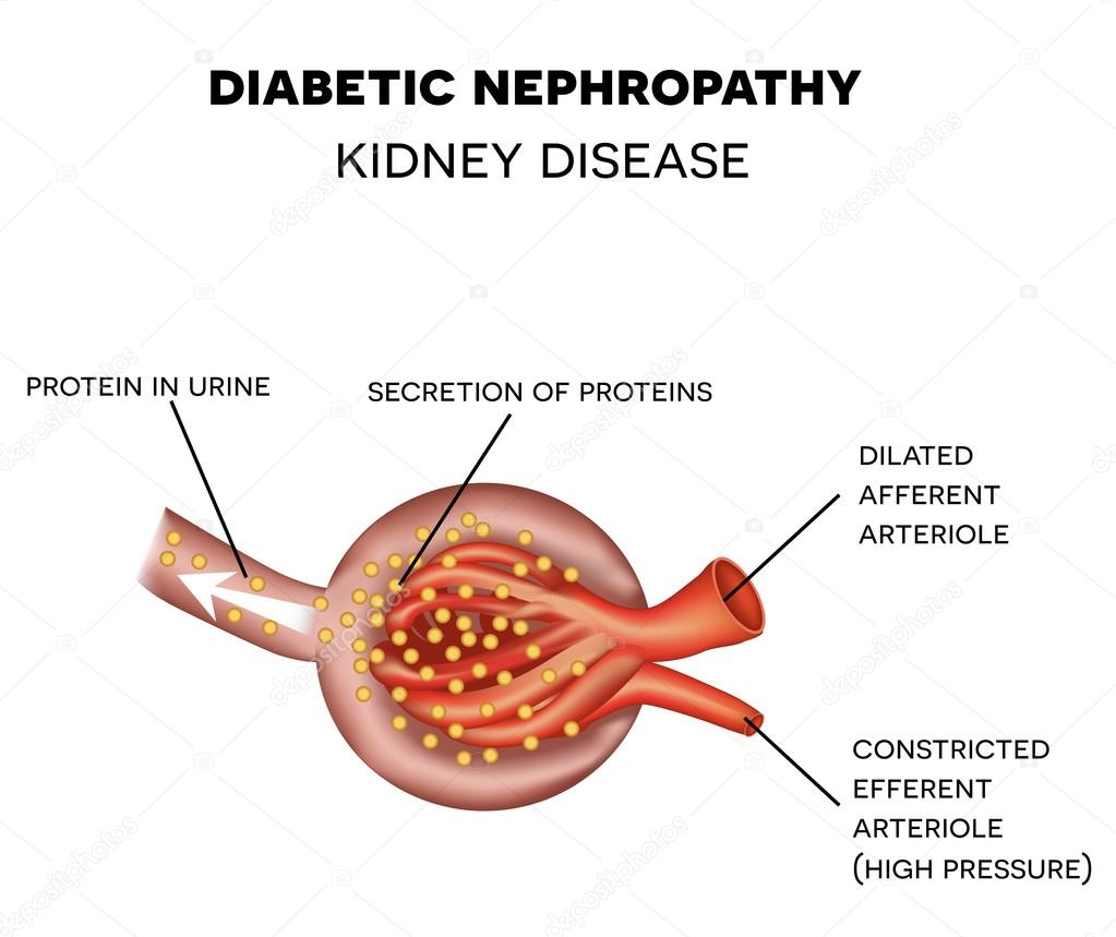 depositphotos_87953020-stock-illustration-diabetic-nephropathy-glomerulus-anatomy