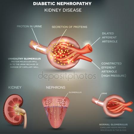 depositphotos_87953018-stock-illustration-diabetic-nephropathy-kidney-disease