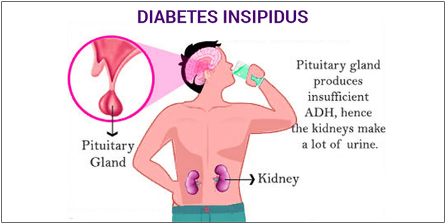 Diabetes-Insipidus