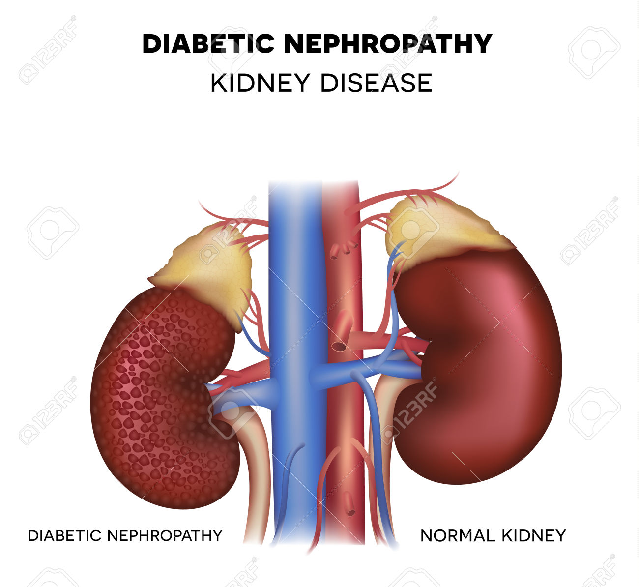 47999985-Diabetic-Nephropathy-kidney-disease-caused-by-Diabetes-Stock-Photo